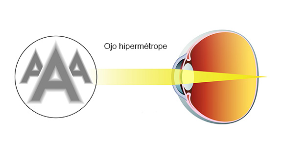 Tipos 2025 de hipermetropia